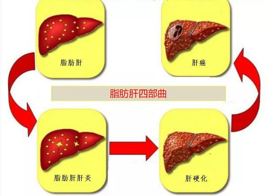 脂肪肝=新肝炎？医生提醒：想要逆转脂肪肝，3个方法很有效